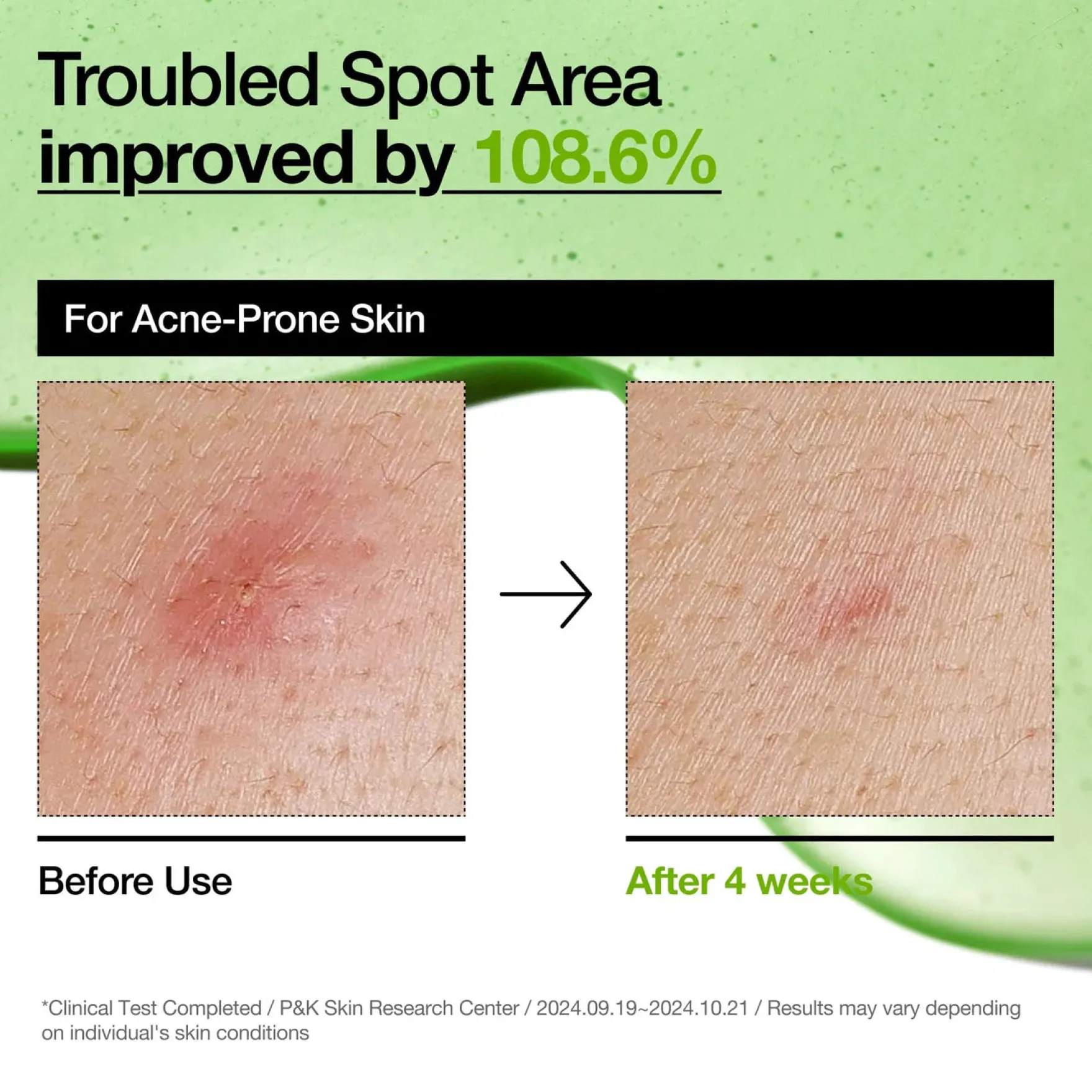 Azelaic Acid 10 Hyaluron Redness Soothing Serum