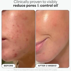 BHA Liquid Exfoliant