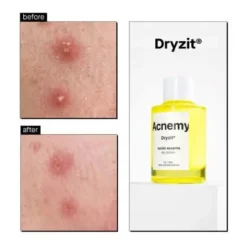 Dryzit Dry Lotion