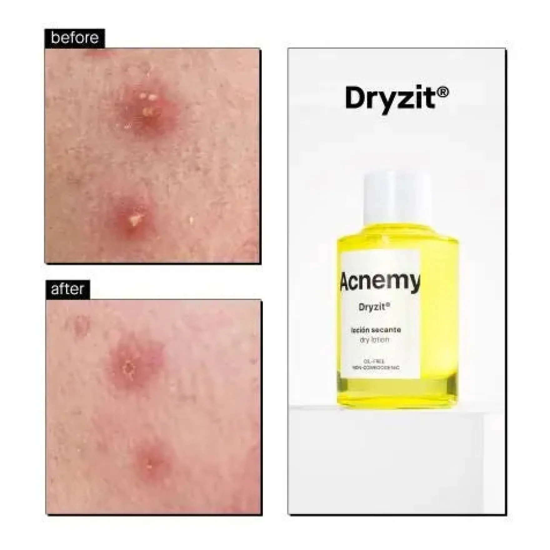 Dryzit Dry Lotion
