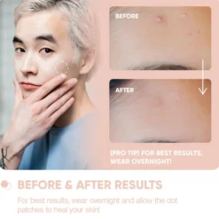 Emergency Dots For Spots and Blemishes Salicylic Acid