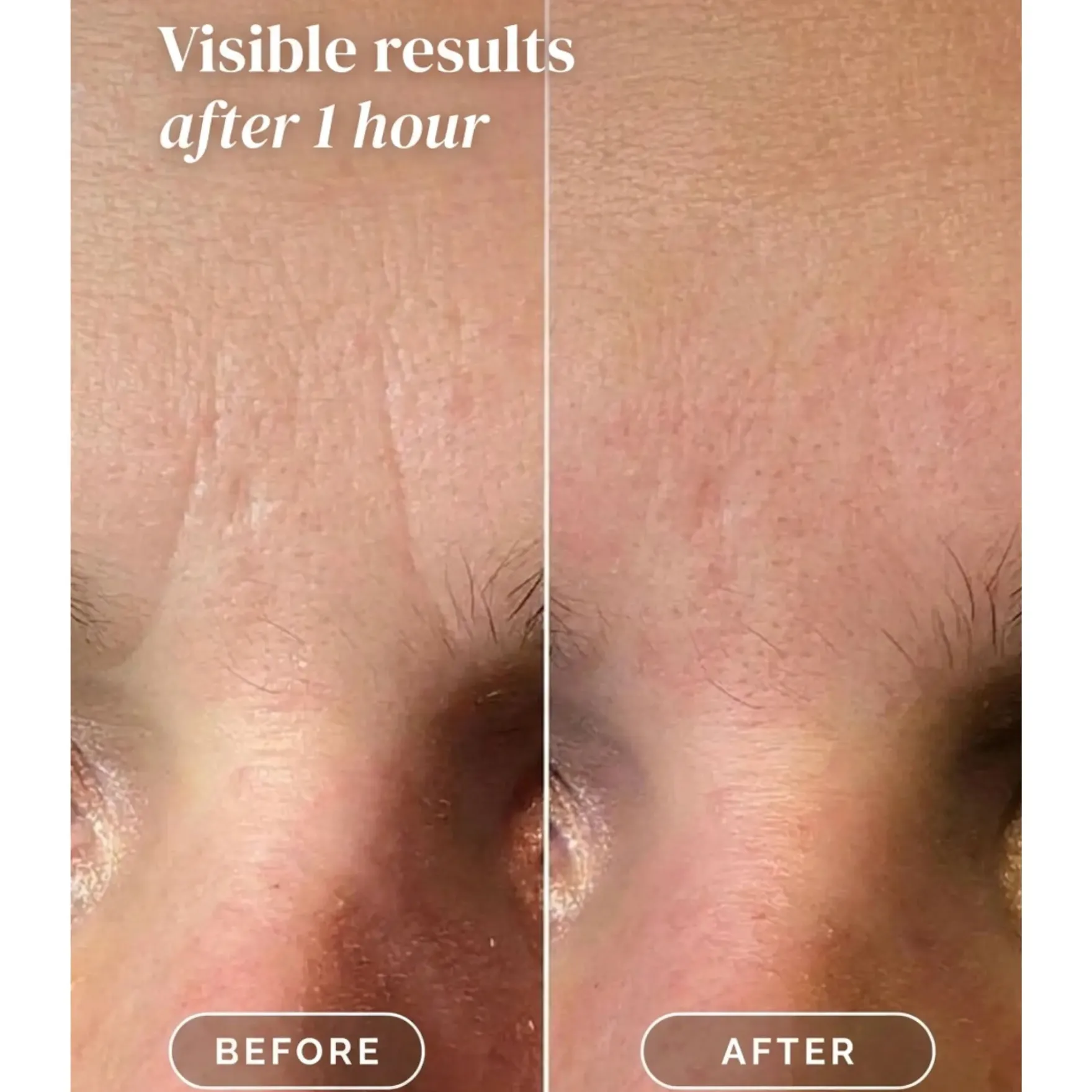 Facial Patches Niacinamide