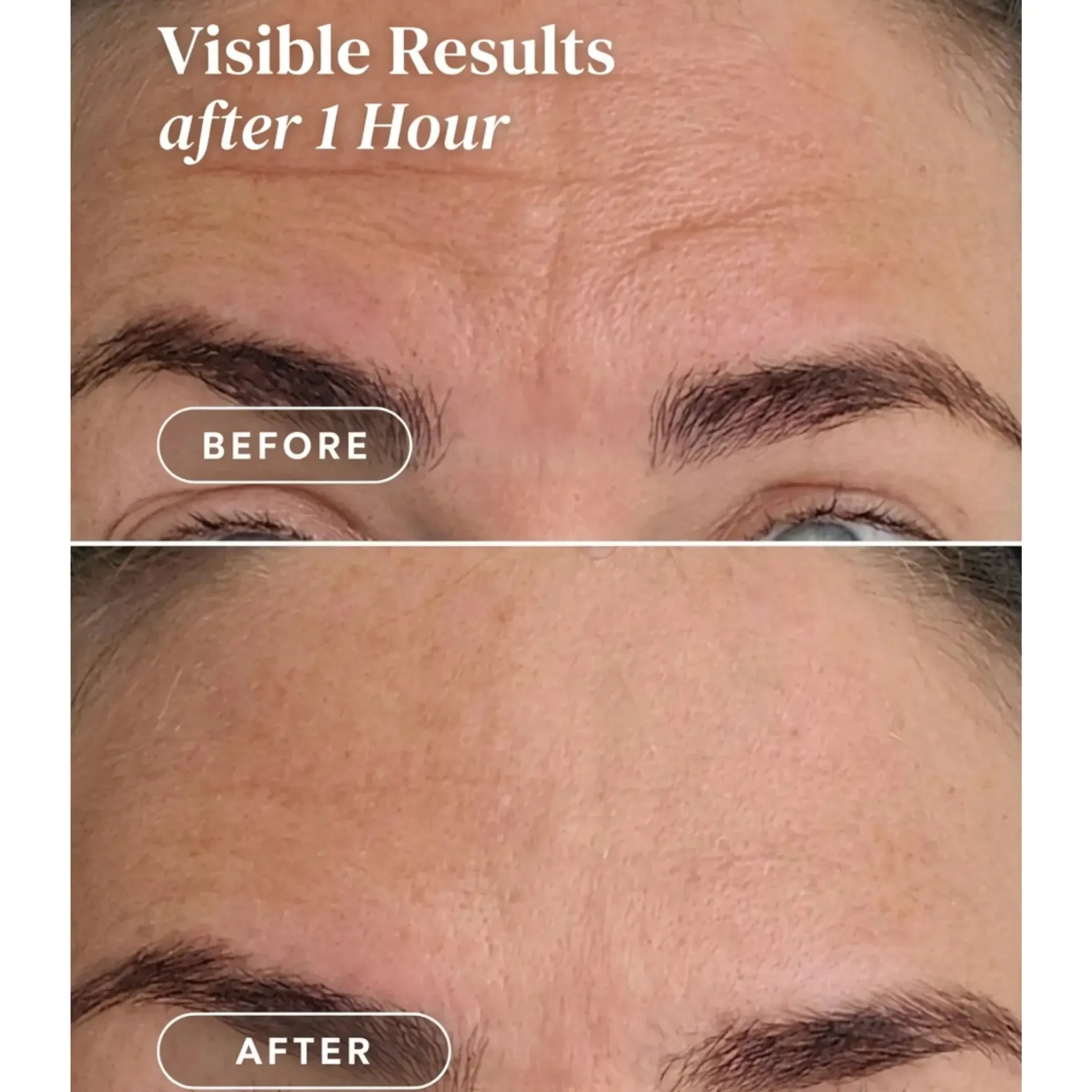 Forehead Pad Ectoin