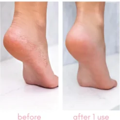 Heel-ing Callus Remover