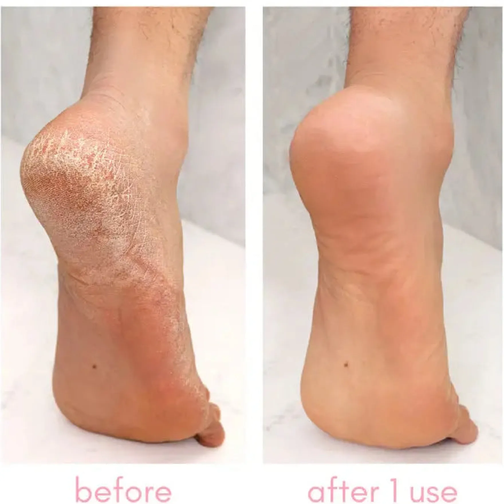 Heel-ing Callus Remover