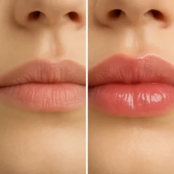 Hyaluronic Acid Lip Filler