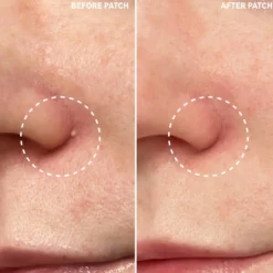 Hydrocolloid Invisible Pimple Patches