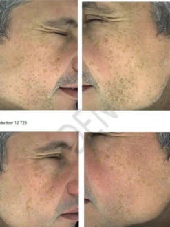 Hyperpigmentation Serum - 2% Alpha Arbutin + 1% Kojic Acid
