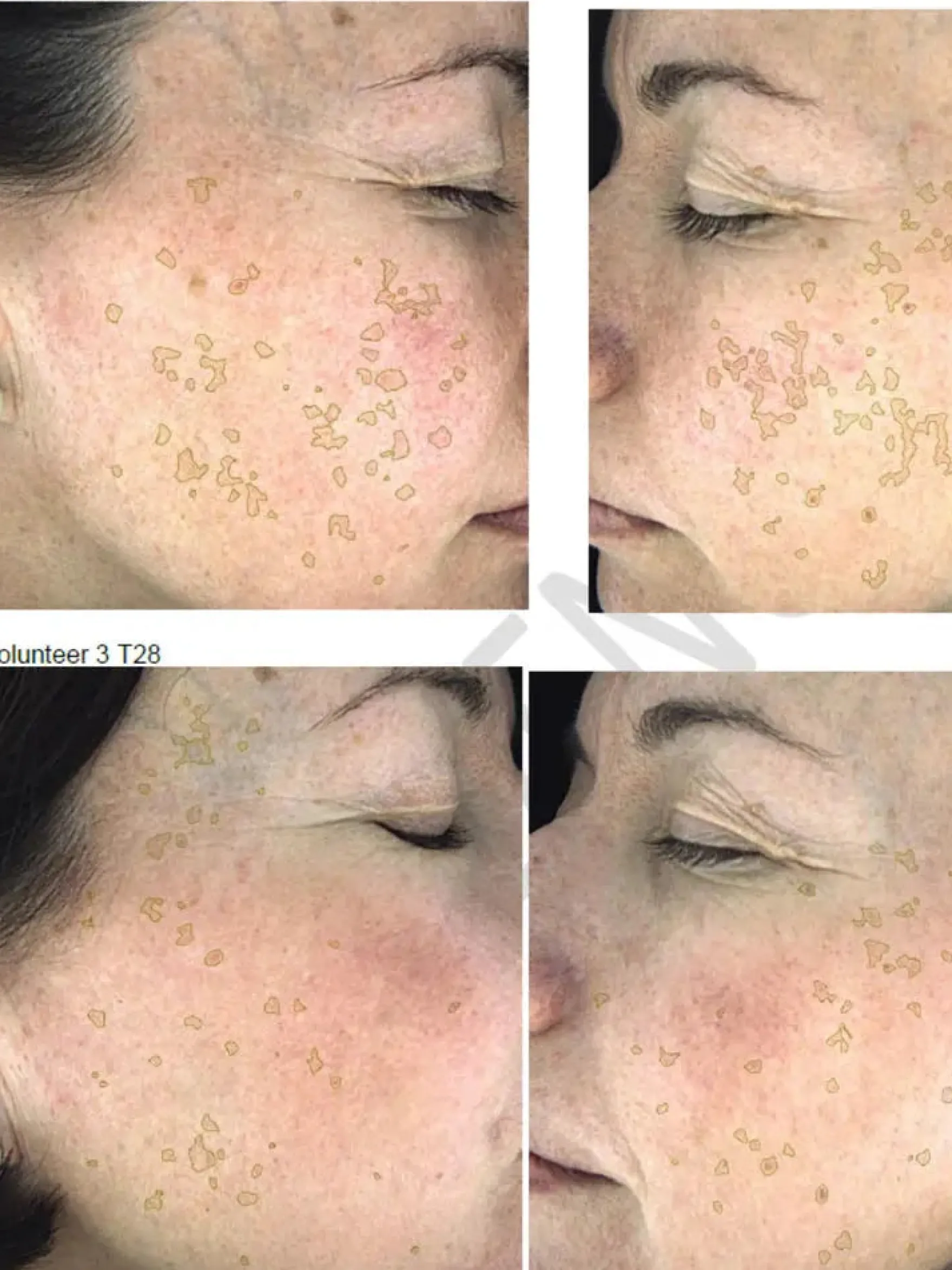 Hyperpigmentation Serum - 2% Alpha Arbutin + 1% Kojic Acid