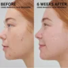 Mandelic Acid Treatment