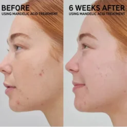 Mandelic Acid Treatment