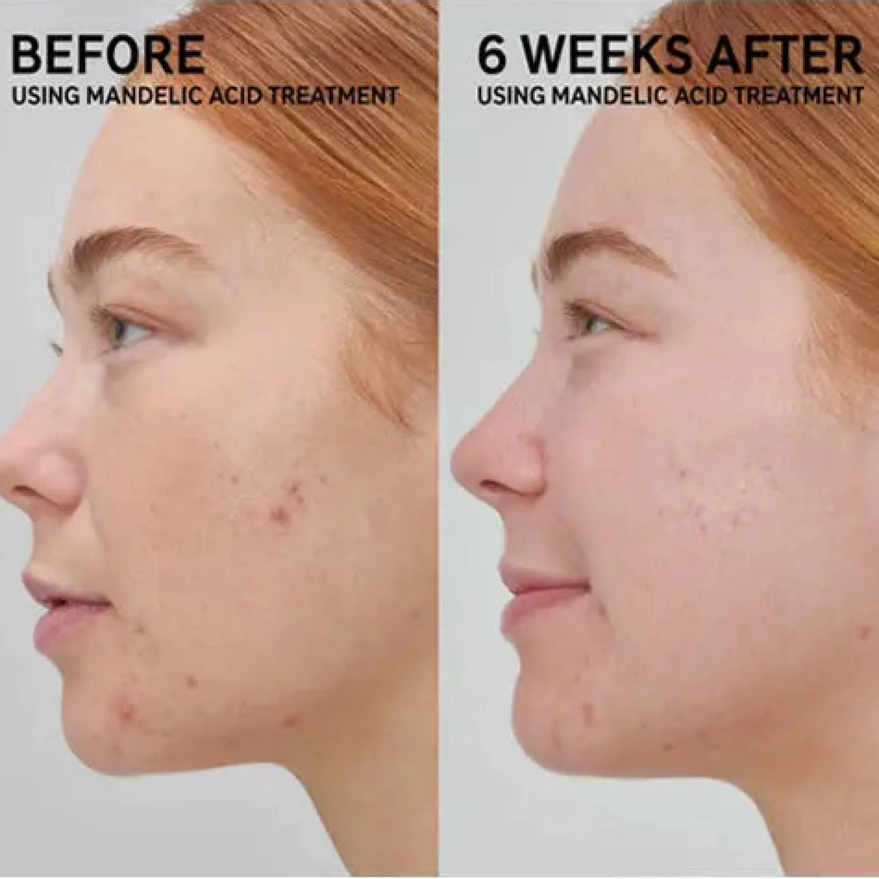Mandelic Acid Treatment