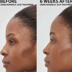 Mandelic Acid Treatment