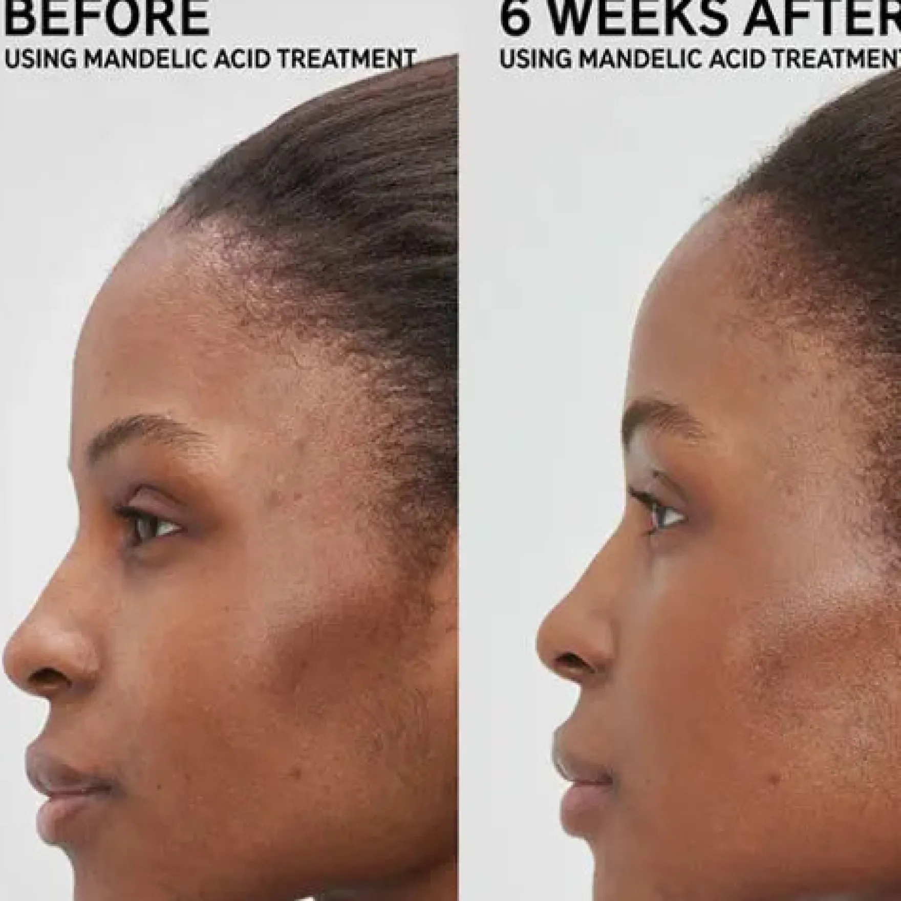 Mandelic Acid Treatment