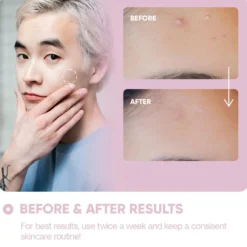Micro Needle Patches For Dark Spots