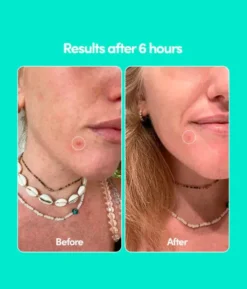 Pimple Patches