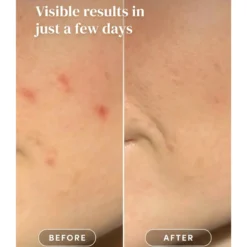 Post Pimple Patches