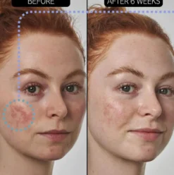 SuperSolutions Redness Relief Solution
