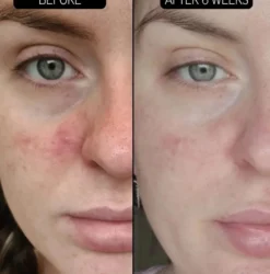 SuperSolutions Redness Relief Solution