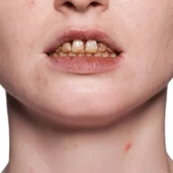 Tooth Enamel Red