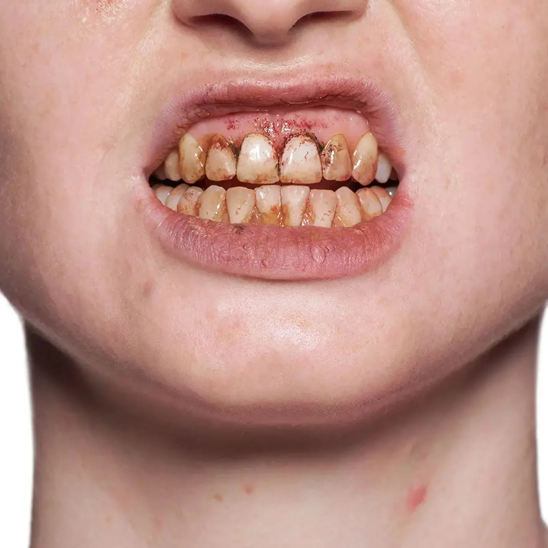 Tooth Enamel Red